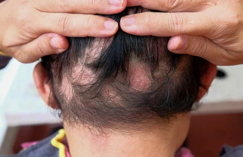 Traction Alopecia: Natural Ways to Reverse Hair Loss and Regrow Hair